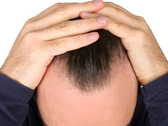 Everything To Do When Sticking With Hair-loss by Boston hair loss center
